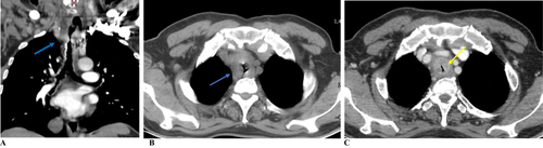 Figure 1 Coronal and axial neck and chest CT scan shows asymmetric nodular thickening of the upper thoracic trachea (blue arrow) with a luminal narrowing >50% (A and B). Axial neck and chest CT scan shows asymmetric soft-tissue thickening of the intrathoracic trachea (yellow arrow) with significant airway narrowing (C).