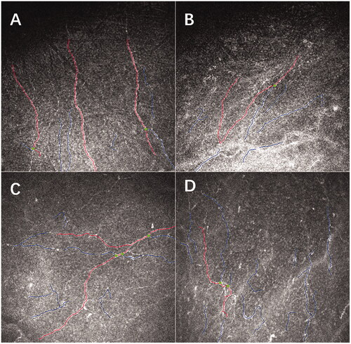 Figure 2. Representative in vivo confocal microscopy images young patients with congenital blepharoptosis revealed very sparse sub-basal nerve plexus. A young patient of 20 years old with unilateral blepharoptosis in his right eye revealed sparse sub-basal nerve plexus (A), as did in his left eye (B). A teenage boy with bilateral blepharoptosis revealed sparse sub-basal nerve plexus in his both eyes (C, D).