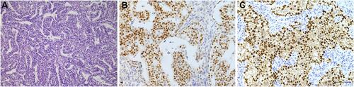 Figure 4 Immunohistochemical staining in EC. ECs demonstrate heterogeneous growth patterns, including solid, complex glandular, or papillary figurations (A). Positivity for TdT in EC (B). The tumors were confirmed by OCT4 (C) (amplification: 10×20, bar=50μm).
