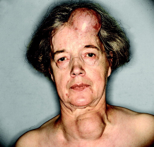 Figure 3.  A 67 year old woman with thyroid cancer and a skeletal metastasis in the forehead.