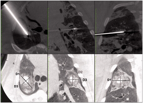 Figure 2. Imaging evaluation of ablation volumes. This figure shows how measurements on immediate post ablation CBCT imaging were performed by 2 radiologists. The line on the top show the coaxial canula placement before MWA probe insertion. The bottom line shows the measurement on post ablation CBCT imaging on multiplanar reconstructions. D1 (in black) : long axis; D2 (in grey) : orthogonal cranio-caudal measure; D3 (dotted line) : orthogonal lateral measure.