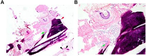 Figure 2 Biopsy, H&E staining, and lamellar bone tissue distributed in the dermis (A). Osteocytes were in the bone tissue, and osteoblasts were seen around bone tissue (B). Black arrows: osteoblast; Green arrows: osteoclast; Red arrow: Lamellar bone tissue.