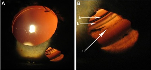 Figure 9 The slit-lamp photo of the peripheral capsule with the ring and Zinn zonules through iridotomy in a patient with previous phakic IOL implantation surgery (a – IOL rim, b – the ring groove, c – anterior capsule zonule attachment). Image B is a higher magnification of the lower right-hand part of image A.
