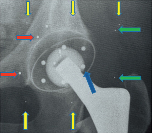 Figure 3. Pelvic radiograph showing the tantalum acetabular and socket markers after implantation of the cementless RM press-fit socket without any additional screw fixation. Yellow arrows: fiducial cage markers; green arrows: control cage markers; red arrows: acetabular bone markers; blue arrow: socket marker.