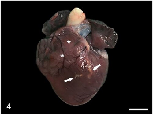 Figure 4. Case 3. The heart exhibits tortuous, yellow, stripes (arrows) that correspond with atheromatous branches of the coronary arteries, and pale areas of myocardium that correspond with areas of degeneration (asterisks).