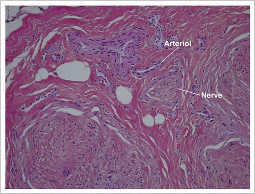 Figure 12 At very high magnification vascular thrombosis is totally absent from both venules and arterioles.