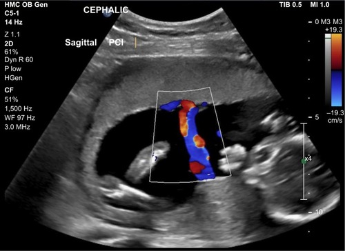 Figure 2 Color flow Doppler ultrasound from singleton pregnancy during a routine fetal anatomy survey showing the PCI to be centrally located on the placental disk.