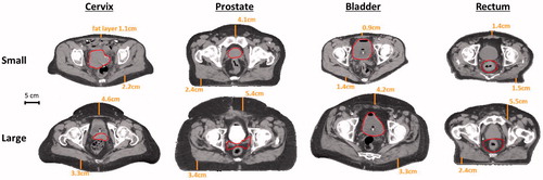Figure 2. Transversal cross-sections of the CT scans for small (i.e. slender) and large (i.e. overweight/obese) cervix, prostate, bladder and rectum cancer patients. The scans of the cervix and bladder cancer patients were standard hyperthermia treatment planning scans for heating with the AMC-4 system, scanned in treatment position, i.e. on a water bolus and mattressess. The prostate and rectum cancer patients were not treated with the AMC-4 system and standard radiotherapy scans were used, recorded on the table of the linear accelerator. Measured fat layer thicknesess are indicated and the red contour represents the target region. Cross-sections are at the centre of the target region in axial direction.