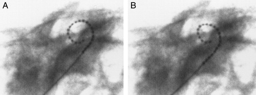 Figure 12. MRA (version 4) showing (A) over-insertion and (B) the same insertion after the electrode is pulled back. Images courtesy of New York University.
