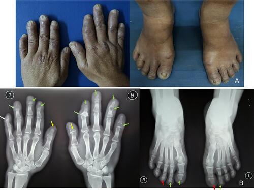 Figure 2 (A) Swollen fingers and toes. (B) Radiographic features showed osteolysis and destruction of some phalanges of the hands, bone erosion and destruction of some phalanges of the feet, and destruction and subluxation of some hand joints. (yellow arrow: osteolysis; green arrow: destruction; red arrow: erosion; white arrow: subluxation).