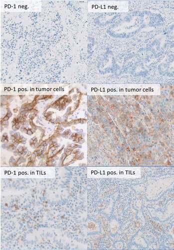 Figure 2. Immunohistochemical staining for PD-1 and PD-L1 expression in tumor cells and TILs in 400fold (b,d,e) and 20fold (a,c,f) magnification.