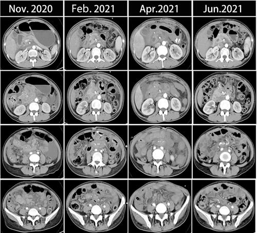 Figure 4 CT scans show the therapeutic response of patients following a series of treatment.