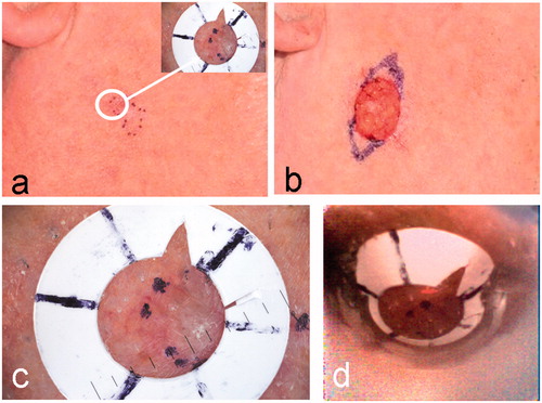 Figure 2. A nodular BCC on the cheek of patient 1 (see Table I). (a) Clinical image showing the pre-surgical border marked in ink dots on the skin. Inset is the dermoscopy image of the fiducial ring after it has been placed over a small segment of the pre-surgical border in the position indicated by the white circle. (b) Clinical image after one stage of MMS. Extended inked marking indicates the pre-surgical border for the planned second MMS stage. (c) An enlargement of the dermoscopy image of a segment of the lesion border and fiducial marker. (d) The webcam image in the registration before rectification.
