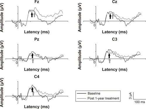 Figure 2 Representative MMN waveforms in patients with obsessive-compulsive disorder. Notes: Black lines: before follow-up, gray lines: after follow-up. The MMN is indicated by arrows.