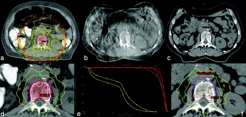 Figure 2.  Patient geometry at simulation (a), at image guidance (b), and in the re-simulation CT (c), including original plan dose (d), the original plan applied to the anatomy of the re-simulation CT scan with no re-optimization, as well as a comparative DVH. DVH lines with square markings denote the original plan, while the lines with triangles represent the original plan applied to the re-simulation CT. PTV is orange-colored, GTV is red, and spinal is cord yellow.