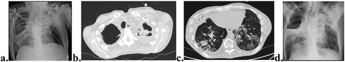 Figure 2. Chest CT and x-ray, 16 months after first Pulmonary Department admission. Significant wider cavitation in the right upper lobe and bilateral reticular infiltrates at the right lower lobe and left upper lobe (LUL) (a). Mass-like lesion (aspergilloma) inside LUL cavitation (b). Diffuse multifocal ground-glass opacities, sub-pleural micronodules, and tree-in-bud (c). Air fluid level at the RUL cavity on X-ray (d).