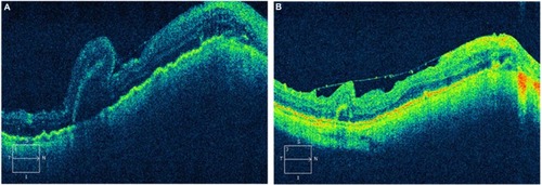 Figure 1 After surgical repair of the retinal detachment and subsequent removal of silicone oil, the postoperative SD-OCT demonstrating chorioretinal folds is shown in (A) with improvement but not complete resolution of the folds in (B).