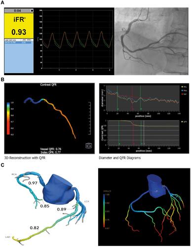 Figure 1 Overview of the different non and less invasive FFR techniques. (A) Example of a non-hyperemic pressure ratio measurement (iFR) of the RCA. (B) Example of angiography-based FFR (QFR) of the LAD. (C) Two examples of CT based FFR (left panel: HeartFlow FFR-CT, right panel: Philips CT-FFR).