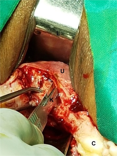 Figure 6 A sub-serosal morcellation technique using a surgical knife (K) that was inserted beneath the serosa to morcellate and decompress the uterine wall (U). Notes: C represented as Cervix. L represented as lateral vaginal wall retractor.