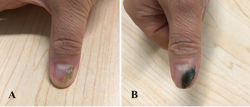 Figure 3 The lesion covered half of the outer edge of the nail plate with yellowish discoloration (A), after 3 months of therapy, and her thumbnail presented with green-black discoloration (B).