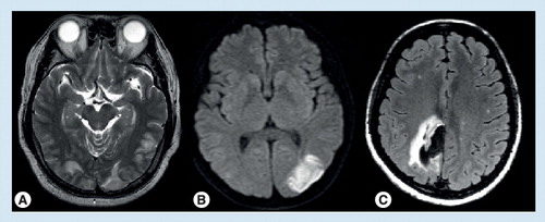 Figure 2. Complications of reversible cerebral vasoconstriction syndromes.(A) Posterior reversible encephalopathy syndrome; (B) cerebral infarction; (C) intracerebral hemorrhage.