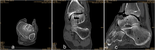 Figure 6. Postoperative CT scans (axial, coronar and sagittal) after graft implantation (pair-point matching with anatomical landmarks).