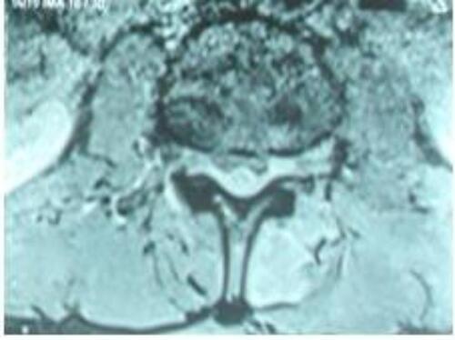Figure 2 Axial MRI of lumbar epidural abscess.
