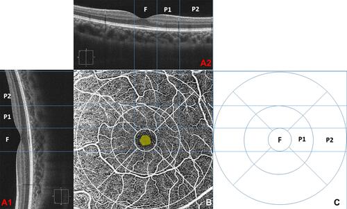 Figure 1 A relationship between PVD location and the corresponding location macular thickness and Angioplex image using the ETDRS method. (A1 and A2) a radial scan of a horizontal and vertical scan. (B) An en-face image of macular and FAZ with ETDRS segmentation (C) the ETDRS macular thickness map. F, P1 & P2 corresponding area of the fovea, para, and peri macular regions.