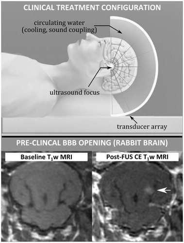 Figure 4. (Top) Treatment set-up for ultrasound therapy using a large aperture array (Courtesy of H. Lin). (Bottom) Baseline axial T1-weighted MRI of a rabbit brain, and corresponding post-FUS, contrast-enhanced image showing enhancement indicating disruption of the BBB at the treated location (arrow).