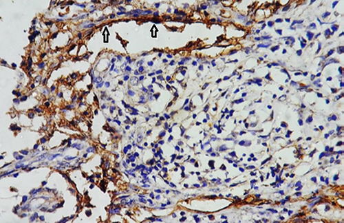 Figure 2 Strong IHC expression of D2-40 in lymphatic vessels (arrows).