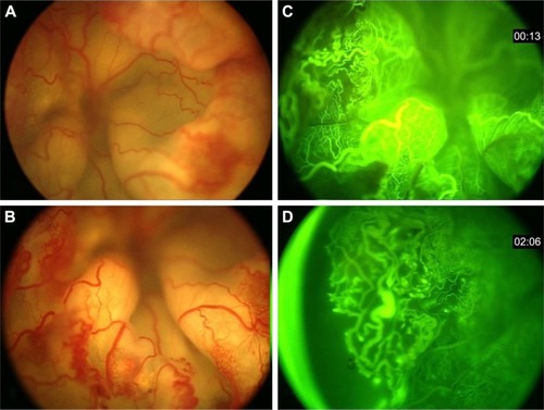 Figure 1 Clinical appearance of a patient with Coats’ disease. (A and B) The fundus image of a patient with Coats’ disease with exudative total retinal detachment. There is central arteriolar mild dilation and tortuosity. Peripheral telangiectatic vessels along aneurysmal changes are visible. Many microvascular shunts nearly in 360° of periphery and midperiphery of retina are evident. (C and D) Angiographic finding as telangiectatic vessels, microaneurysms, sacular aneurysms, shunt vessels and peripheral avascular area in temporal and inferior retina.