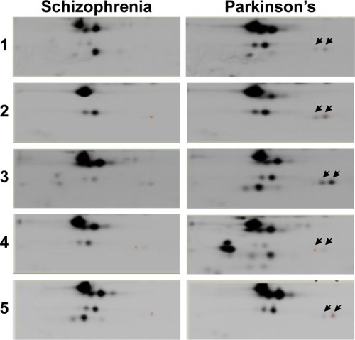Figure 3 Magnified view of the gels showing the varying expression of proteins in patients with Parkinson’s disease and schizophrenia. Images correspond to the two phenotypes from five biological replicate gels. The protein spots that were picked for identification are indicated by black arrows.