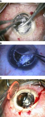 Figure 3 (A) Completion of stromal dissection near the pre-descemetic plane at the Descemet’s membrane tear with a scissor. (B and C) Applying the graft after completion of stromal dissection to a pre-descemetic plane (Intraoperative picture).