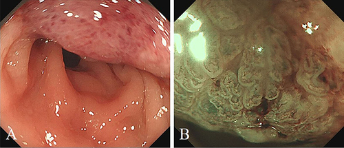 Figure 1 (A) White-light endoscopy showed a slightly elevated lesion more than 10mm, with irregular surface structure and a demarcation line. (B) Magnify narrow-band imaging (NBI) endoscopy showed that the lesion was classified as capillary patterns (CP) type IIIB according to the NBI CP classification.