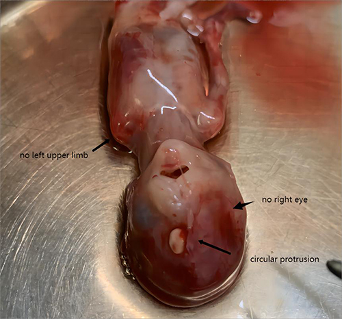 Figure 5 The fetus underwent induced labor. The short black arrow indicates that the left upper limb is not visible in the image. The long black arrow indicates a circular protrusion in the middle of the forehead. The thick, short black arrow indicates no eye in the right orbital position.