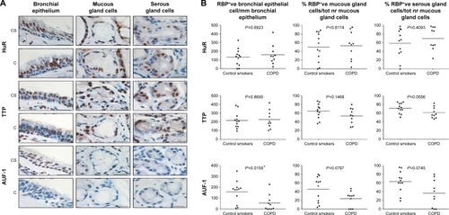 Figure 1 Expression of RNA-binding proteins in human bronchial rings.Notes: (A) Photomicrographs showing immunostaining for HuR, TTP, and AUF-1 in bronchial epithelium, mucous gland cells, and serous gland cells (left to right) from a CS with NLF and a patient with mild-to-moderate COPD (C) (representative of n=12 for each group, see the “Methods” section). Scale bar set at 20 µm. (B) Individual and median (line) cell counts of nuclear immunostaining for HuR, TTP, and AUF-1 in bronchial epithelial cells, mucous gland cells, and serous gland cells (left to right) of CS and COPD, normalized as indicated. Student’s t-test P-value for COPD vs CS is indicated in all panels. *P<0.05 vs CS. Scale bar set at 20 µm, magnification 1,000×.Abbreviations: C, patients with COPD; HuR, human antigen R; TTP, tristetraprolin; AUF-1, AU-rich element-binding factor 1; NLF, normal lung function; CS, control smoker.