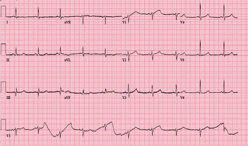 Figure 4. EKG following resolution of chest pain showing normalization of ST elevation in lateral leads (I, aVL) and ST depression in inferior leads (III, aVF)