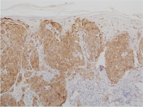 Figure 3 Immunohistochemistry using antibodies against mutated BRAF.Notes: The tumor cells are BRAF-mutated as indicated by the immunohistochemical positivity for anti-BRAF V600 antibody; ×100.