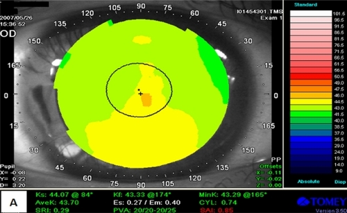 Figure 1-A Patient 1: Preoperative LASIK: TMS with normal elevation.
