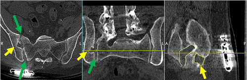 Figure 2 (Case 1): CT scan shows large bone voids (yellow arrows) and joint widening (green arrows) after removal of SA from right SI joint after increasing pain with suspected infection and inflammatory reaction. Circled regions show area of joint destruction and bone void.