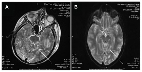Figure 2 Imaging of the central nervous system post seizure showing posterior reversible encephalopathy syndrome versus Mycobacterium avium-intracellulare cerebritis/meningitis versus immune reconstitution inflammatory syndrome. (A) Brain magnetic resonance imaging (MRI) with gadolinium performed on January 16, 2010, and showing bilateral occipital lobe and left temporal lobe edema. The appearance is diagnostic of cerebral edema and could be suggestive of posterior reversible encephalopathy syndrome (arrow indicates gyri with obliterated sulci, suggestive of cerebral edema). (B) Brain MRI with and without gadolinium performed on February 22, 2010, and showing resolution of the cerebral edema after a long course of treatment for Mycobacterium avium-intracellulare (arrow indicates a comparable area showing gyri with distinct sulci, suggesting resolution of cerebral edema).