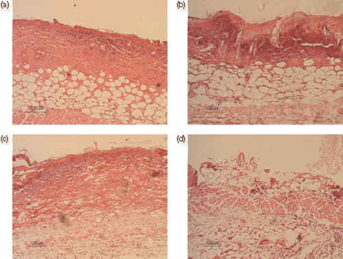 Figure 3. Histological sections of the central area of the burned wounds in four groups. (a) Histological section of burned wound of group 1 (burn without any treatment), 24 h after the burn injury. There were no hair follicles in the central area of the wound. (H & E, 10×). (b) A burn wound of group 2 (burn + hyperthermia), 24 h after the burn injury. There were a few hair follicles in the central area of the wound (H & E, 10×). (c) A burn wound of group 3 (NLX + burn), 24 h after the burn injury. There were no hair follicles in the central area of the wound. (H & E, 10×). (d) A burn wound of group 4 (NLX + burn + hyperthermia), 24 h after the burn injury. The burned wound had changed into a severe third degree burn wound. There were no hair follicles in the central area of the wound. (H & E, 10×).