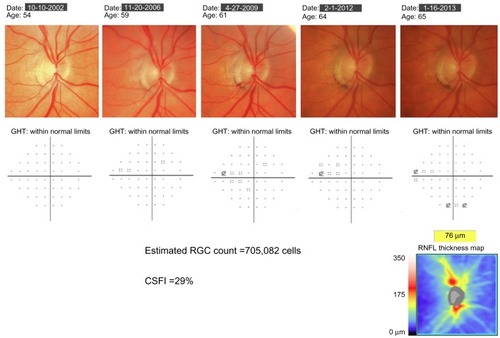 Figure 3 Example of a patient with progressive glaucomatous changes on optic disc photographs. Throughout follow-up, standard automated perimetry indices, including the glaucoma hemifield test (GHT) and mean deviation, remained within normal limits. At the most recent visit, spectral domain optical coherence tomography showed evidence of inferior retinal nerve fiber-layer loss. The estimated retinal ganglion cell (RGC) count at the most recent follow-up was 705,082 cells, and the combined structure–function index (CSFI) was 29%, indicating the eye had lost 29% of RGCs compared to that expected in a healthy age-matched eye.