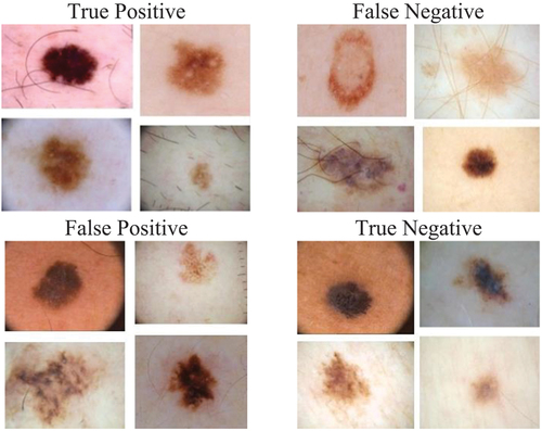 Figure 6. Sample of the Training images used to diagnose skin canc.