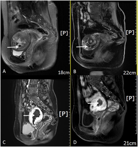 Figure 2. MRI of the uterine lesion pre-HIFU (A and B) and post-HIFU (C and D) treatment. Sagittal T2 image showing the uterine lesion of GTN located in the posterior wall and left horn of the uterus. The size was 3.6 cm. Flow void effect was seen (arrow pointing in Figure A) (A). Sagittal contrast-enhanced image showing the rich blood flow signal of the lesion (B). Sagittal contrast-enhanced imaging performed one day after the surgery showed no perfusion of uterine lesion (C). Sagittal contrast-enhanced image showing the shrinkage of the uterine lesion 22 days after HIFU treatment (size: 2.6 cm) (D). MRI, magnetic resonance imaging; HIFU, high-intensity focused ultrasound; GTN, gestational trophoblastic neoplasia.