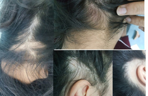 Figure 2 A patient with occipital and temporal patches showing complete hair regrowth after single injection of ILT10 mg/mL.