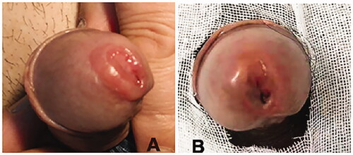 Figure 1. (A) The mass located around ostium of urethra at the glans increased in volume and was pale red. (B) The mass at the outism of urethra and penile urethral decreased significantly.