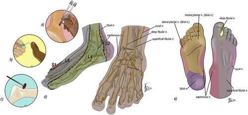 Figure 1 (a) 128hz Tuning fork for vibratory testing. (b) 10g Semmes Weinstein monofilament test evaluates light touch perception. (c) Achilles reflex testing. (d) Normal foot anatomy and innervation to the foot. Right includes a dermatomal overlay. (e) Corresponding sensory territories of the main nervous supply to the foot.
