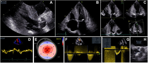 Figure 2 Echocardiographic evaluation at diagnosis. (A) 2D TTE, parasternal long-axis view in diastole where the maximum wall thickness was measured (24 mm at the level of basal interventricular septum). One can also observe the calcified aortic valve and posterior mitral ring. (B) 2D TTE, apical 4 chambers view in systole showing severe LV hypertrophy, a small cavity of the LV, biatrial enlargement, thickened RV free wall, a small pericardial effusion near the right atrial roof and a posterior mitral ring calcification. (C) 2D TTE, apical triplane imaging of the LV in diastole illustrating the apical 4 chambers, 2 chambers and 3 chambers views where one can confirm the severe LV hypertrophy with the calcified closed aortic valve. (D) Low myocardial systolic and protodiastolic velocities (3 cm/s) measured by TDI from the 2D TTE apical 4 chambers view at the level of the interventricular septum. (E) Automated function imaging derived from the 2D speckle tracking echocardiography revealing severe longitudinal systolic dysfunction of the LV (GLS= −9.1%) with a particular apical sparing pattern of the bull’s eye view which is highly suggestive of CA. (F) 2D TTE, continuous-wave Doppler evaluation of the aortic valve from the apical 5 chambers view revealing low transaortic peak velocity (2.7 m/s) and pressure gradients (30 and 17 mmHg, respectively), but with a small AV area estimated by continuity equation (0.8 cm2, 0.46 cm2/m2) consistent with a low-flow low-gradient severe AS phenotype. (G) 2D TTE, pulsed wave Doppler with the sample located at the level of the left ventricle outflow tract, measuring a Velocity Time Integral of 15.1 cm and a SV index of 29 mL/m2. (H) Transesophageal echocardiography with 3D multiplanar reconstruction at the level of the AV where a small planimetric valve area (0.7 cm2) was measured.