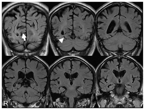 Figure 1 Magnetic resonance imaging coronal sections of fluid-attenuated inversion recovery images on first examination. The calcarine sulcus (arrow) and collateral sulcus (arrow head) were broader on the right than the left. The finding was temporo-parieto-occipital lobe atrophy with right-side dominance.